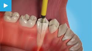 Root canal treatment in Patel Nagar