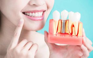 Dental Implant in Delhi