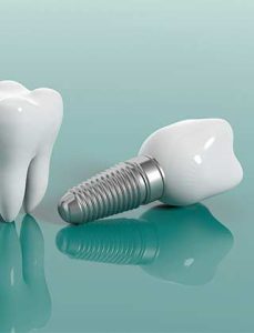 dental implants