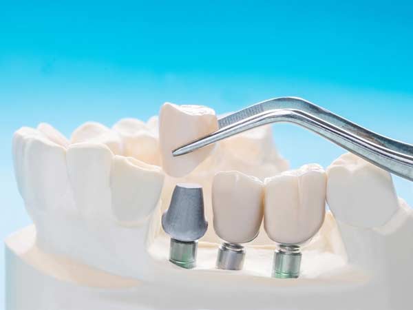 dental implant in Delhi