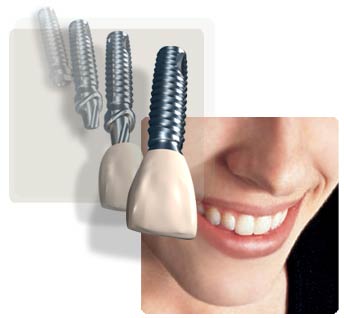 dental implant in Kirti Nagar